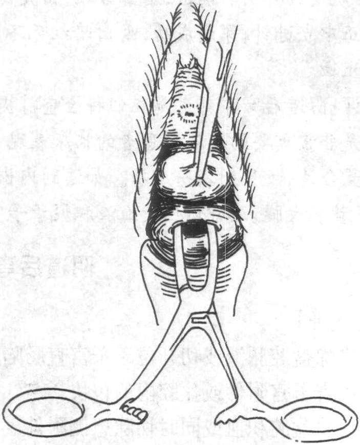 第五節(jié) 陰道后穹穿刺與切開(kāi)術(shù)